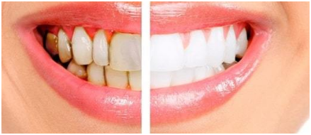 teeth whitening