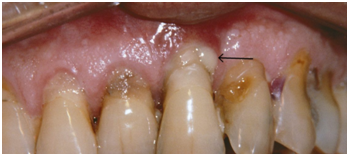 gums problem or pyrrhoea