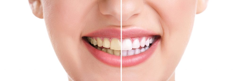 whitening of teeth