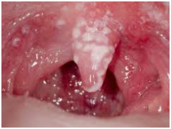 oral thrush