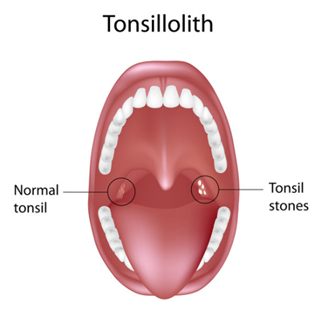 tonsil