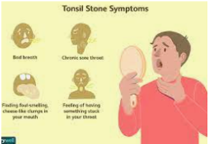 tonsil enlarge