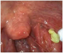 tonsil