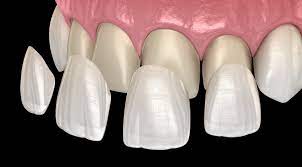 dental veneers on front teeth