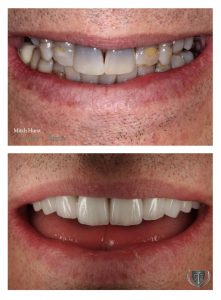 Badly decayed and stained teeth treated using emax crowns