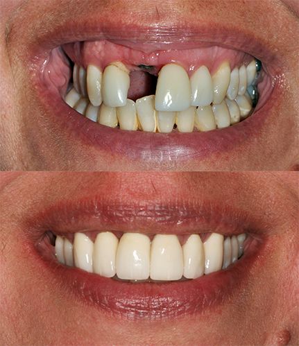 Smile makeover with ceramic bridge