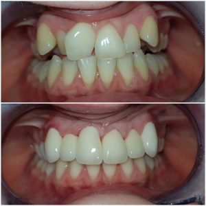 Cosmetic makeover using zirconia crowns