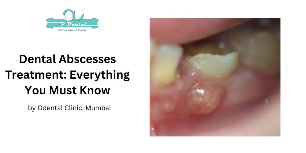 Dental Abscesses Treatment: Everything You Must Know - Odental