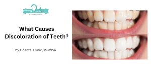 What Causes Discoloration of Teeth