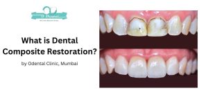 What is Dental Composite Restoration