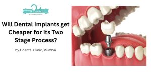 Will dental implants get cheaper